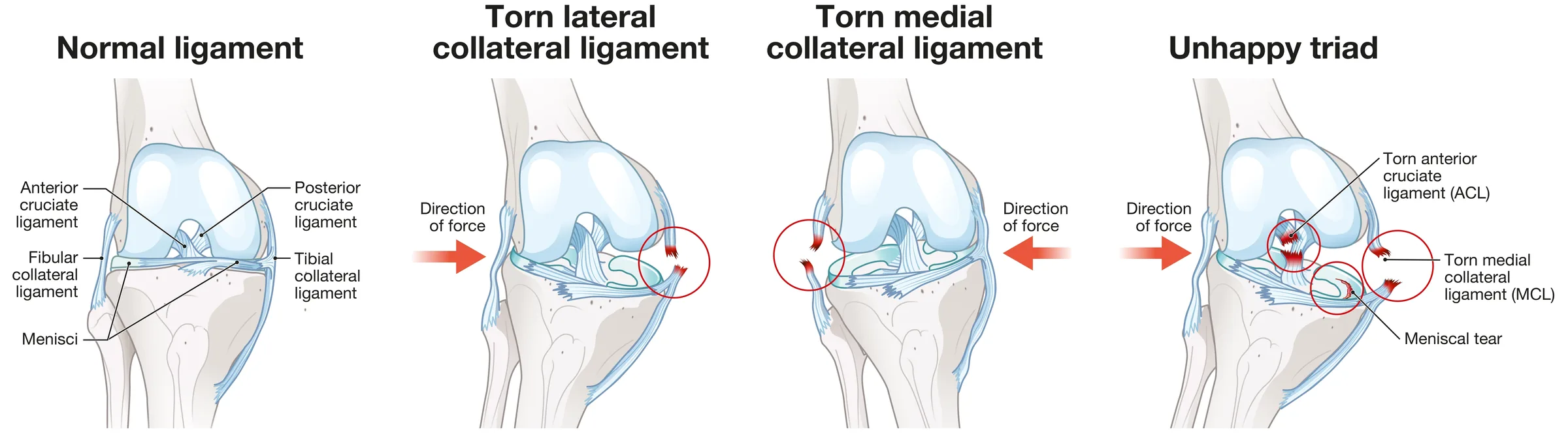 PCL Surgery Dubai — Dr. Konchwalla, ACL PCL Surgeon at Medcare Hospital