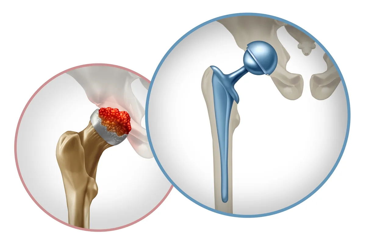 Hip replacement illustration